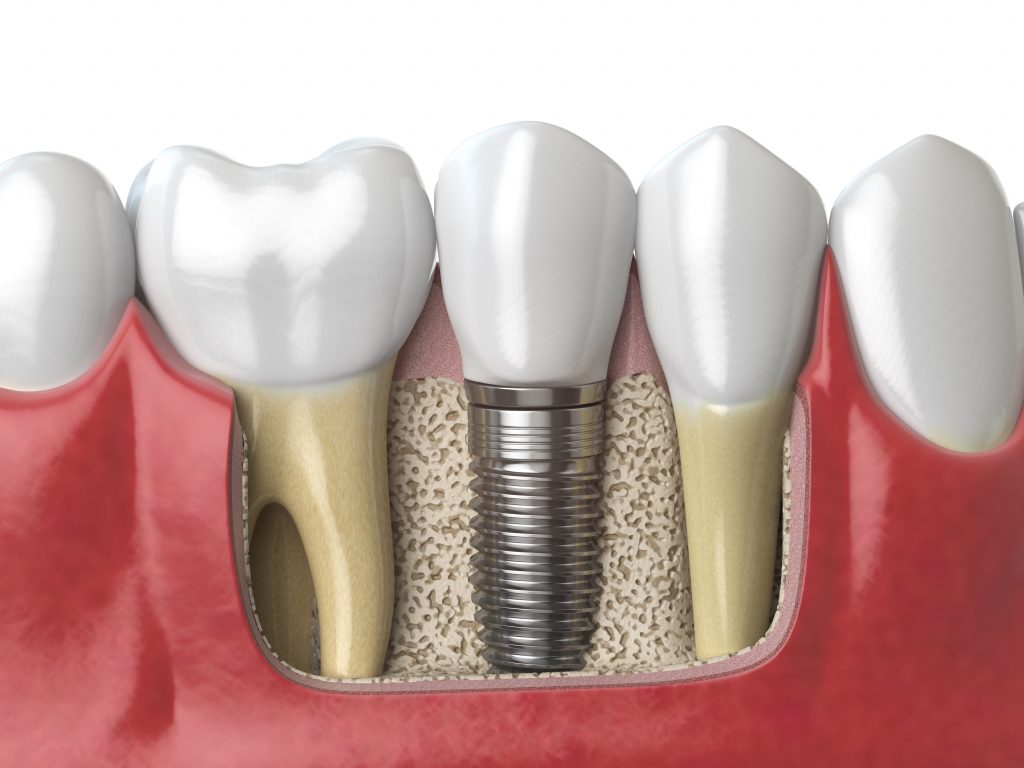 What Is A Dental Implant