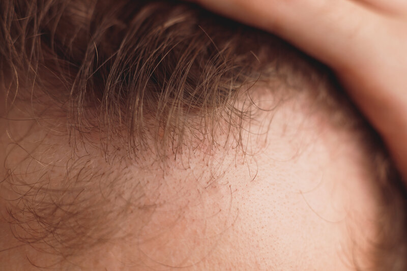 Male Pattern Baldness